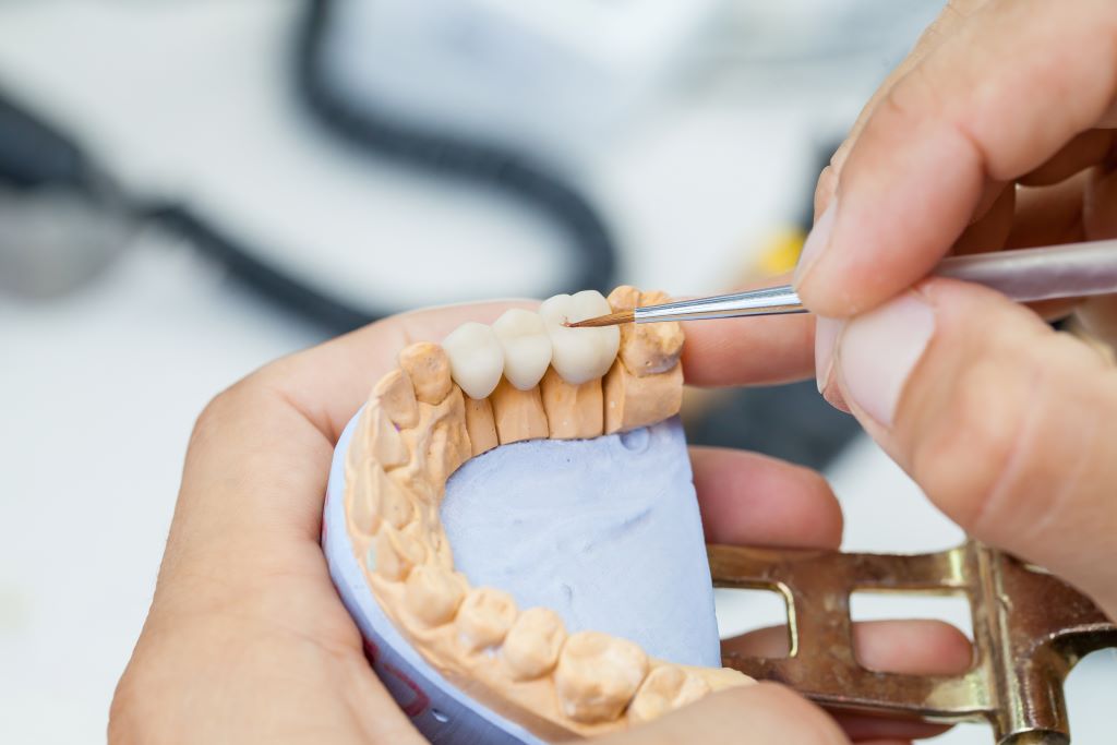 dental bridges in red deer