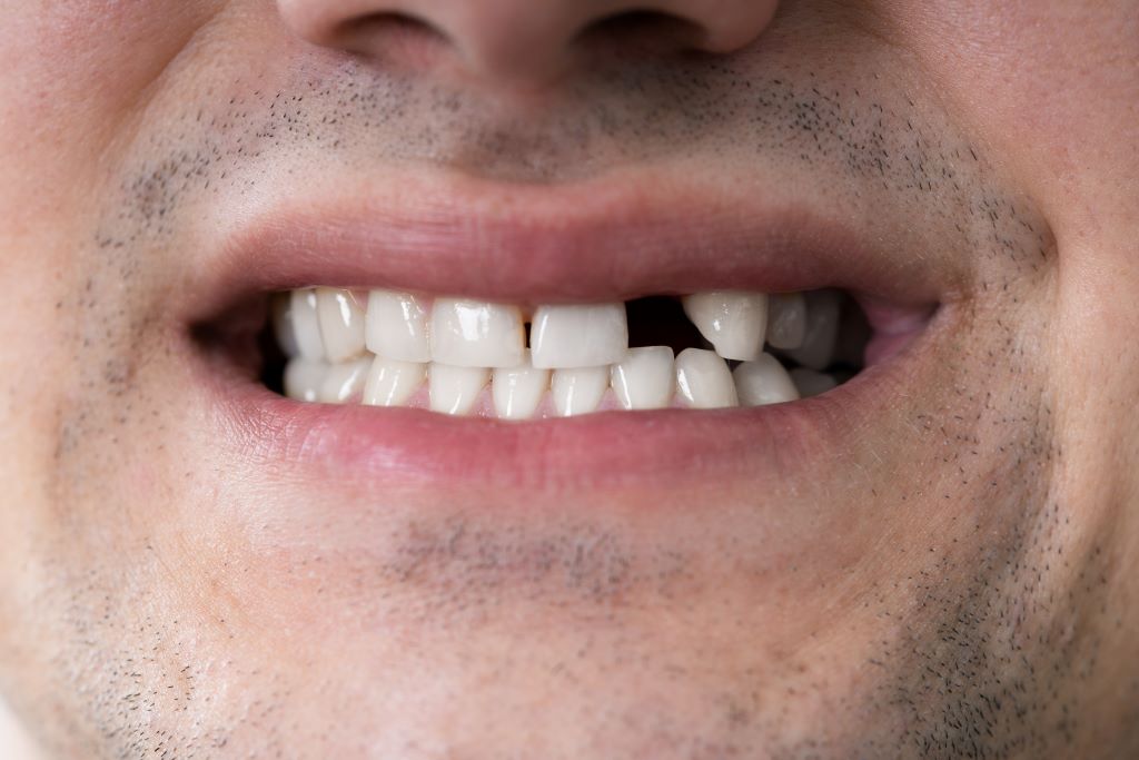 dental implants in red deer