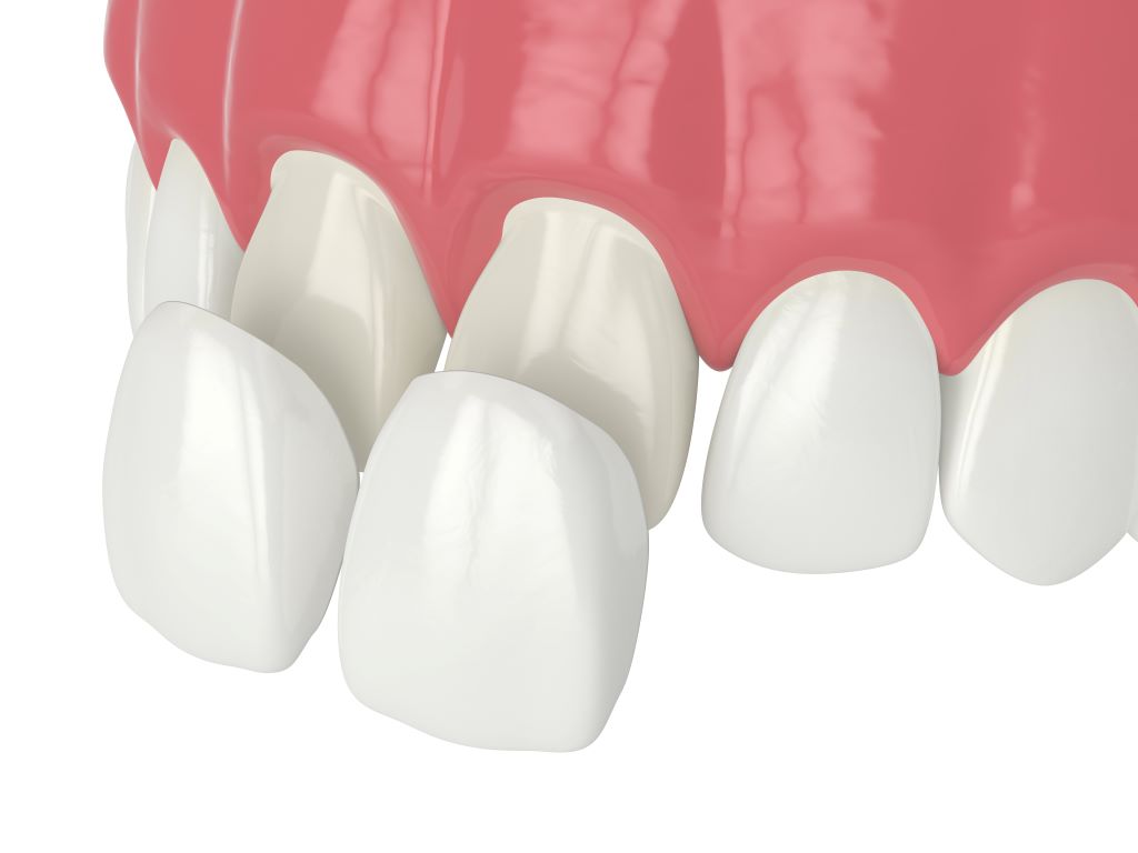 dental veneers in red deer